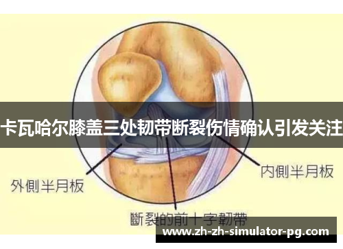 卡瓦哈尔膝盖三处韧带断裂伤情确认引发关注